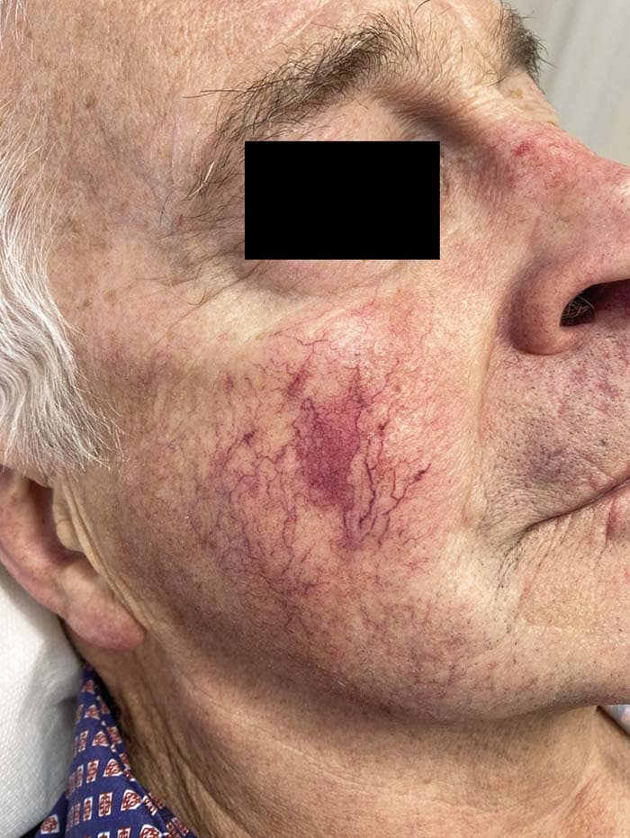 A Behandlung Lumecca