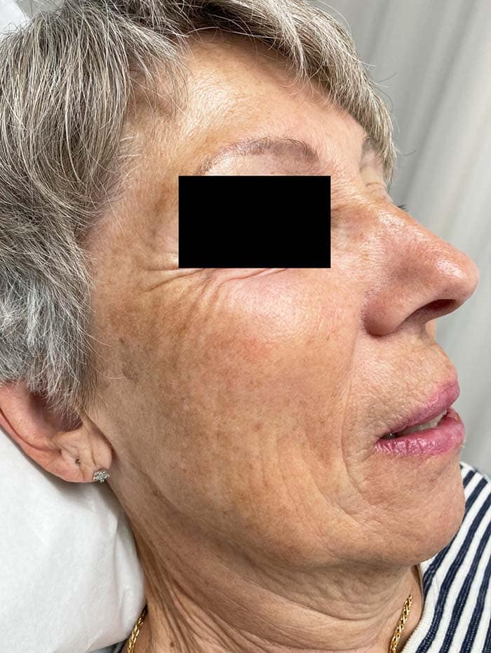 Nach Lumecca Behandlung