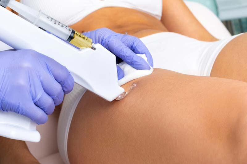 Cellulite Behandlung mit Mesotherapie Cellulite Behandlung mit Mesotherapie