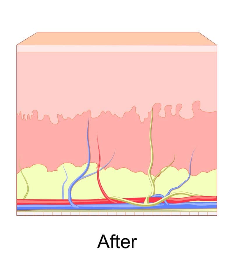 Medical MicroNeedling after Medical MicroNeedling after