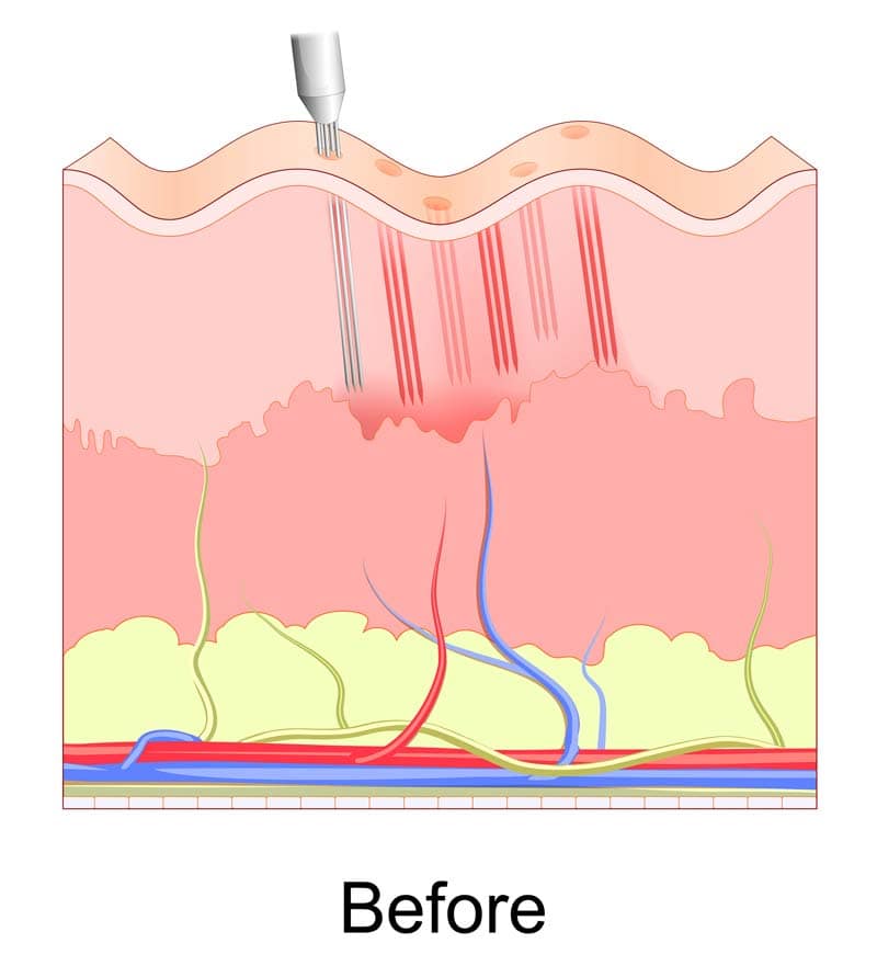 Medical MicroNeedling before Medical MicroNeedling before