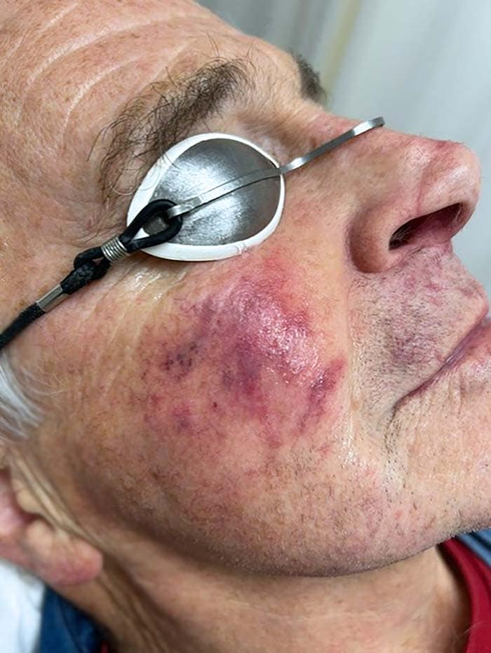 B Behandlung Lumecca B Behandlung Lumecca