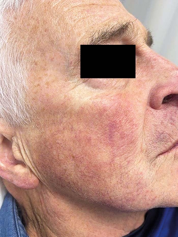 C Behandlung Lumecca C Behandlung Lumecca